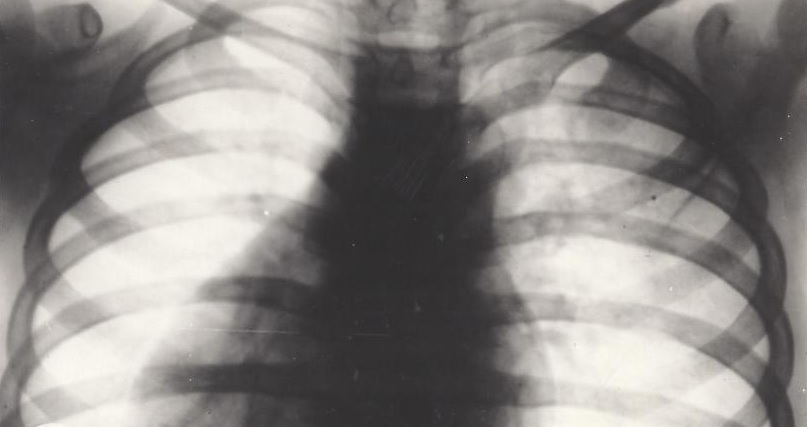 x-ray_of_child_chest_fda_public_domain_.jpg